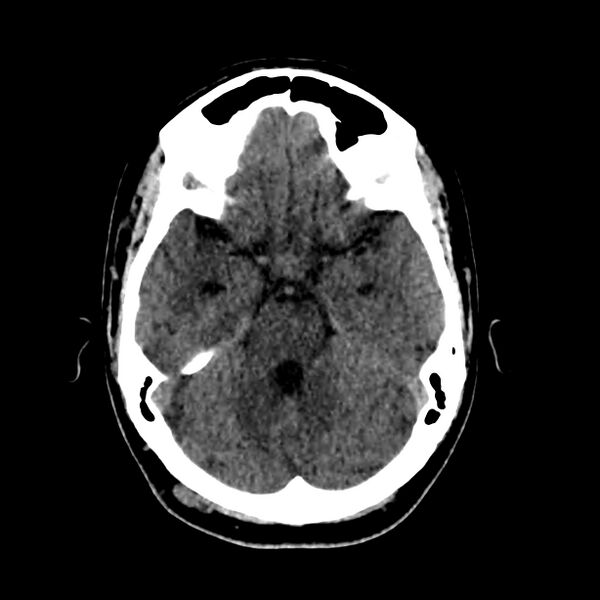 File:Central nervous system Langerhans cell histiocytosis (Radiopaedia 65728-74878 Axial non-contrast 19).jpg