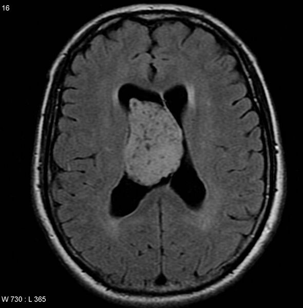 File:Central neurocytoma (Radiopaedia 4956-6850 Axial FLAIR 1).jpg