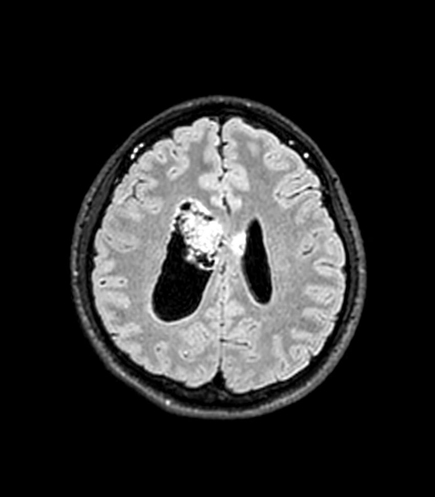 Central neurocytoma (Radiopaedia 79320-92380 Axial FLAIR 111).jpg