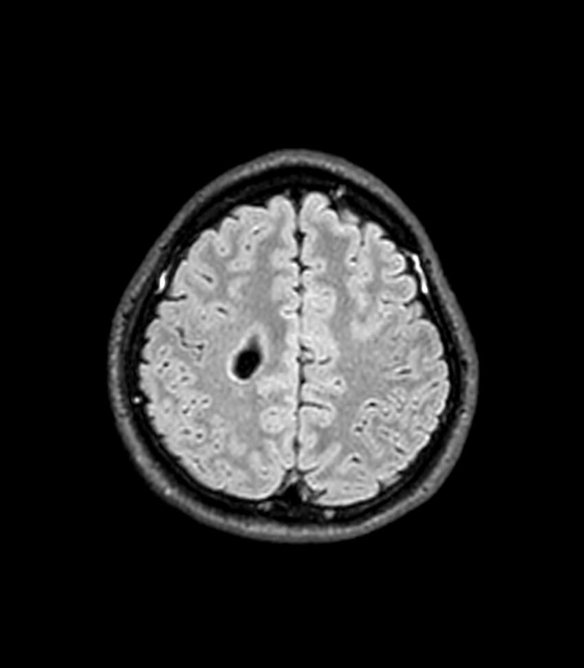 Central neurocytoma (Radiopaedia 79320-92380 Axial FLAIR 84).jpg