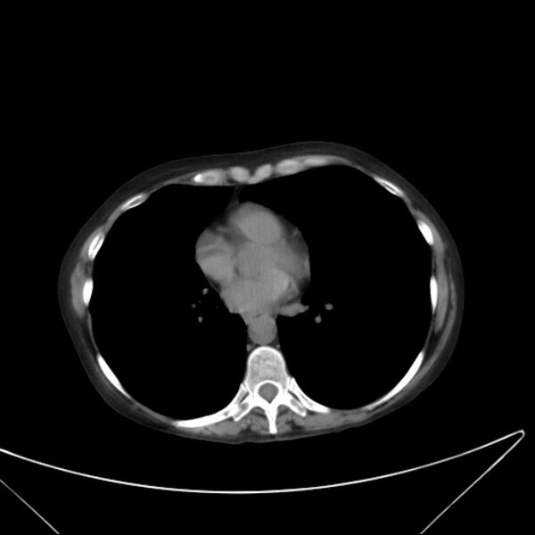 File:Centrilobular pulmonary emphysema (Radiopaedia 24495-24789 Axial non-contrast 30).jpg
