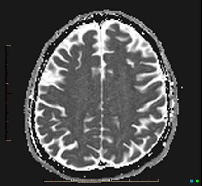 File:Cerebellar gangliocytoma (Radiopaedia 65377-74422 Axial ADC 28).jpg