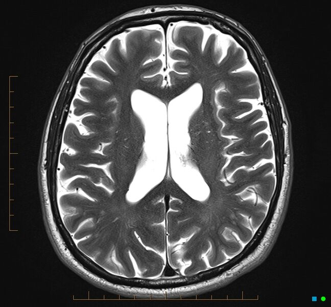 File:Cerebellar gangliocytoma (Radiopaedia 65377-74422 Axial T2 23).jpg