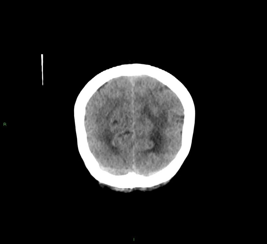 Cerebellar hemorrhage (Radiopaedia 58793-66027 Coronal non-contrast 15).jpg