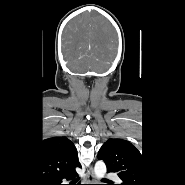 File:Cerebellar infarct due to vertebral artery dissection with posterior fossa decompression (Radiopaedia 82779-97029 D 50).png