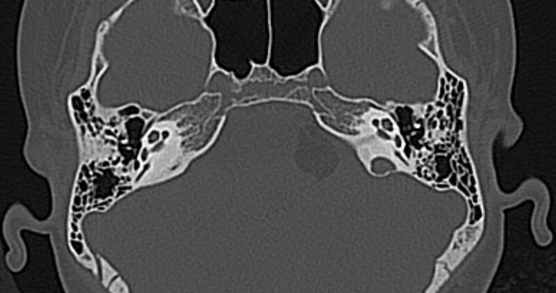File:Cerebellopontine angle lipoma (Radiopaedia 57303-64242 Axial bone window 26).jpg