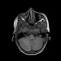 Cerebral abscess post cardiac surgery (Radiopaedia 27244-27420 Axial T1 5).jpg