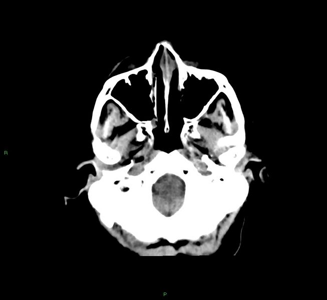 File:Cerebral amyloid angiopathy-associated lobar intracerebral hemorrhage (Radiopaedia 58751-65972 Axial non-contrast 44).jpg