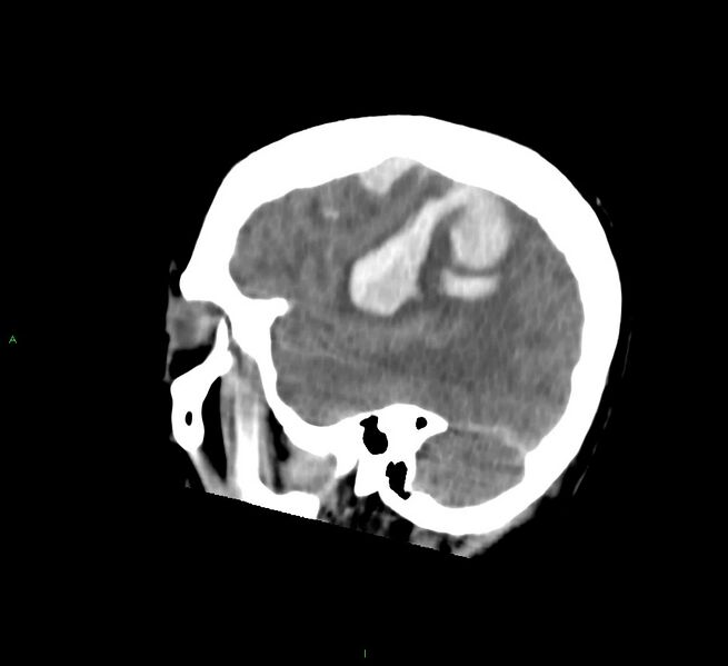 File:Cerebral amyloid angiopathy-associated lobar intracerebral hemorrhage (Radiopaedia 58756-65977 C 15).jpg