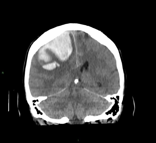 File:Cerebral amyloid angiopathy-associated lobar intracerebral hemorrhage (Radiopaedia 58756-65977 Coronal non-contrast 27).jpg