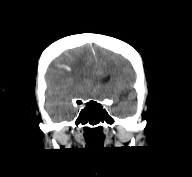 File:Cerebral amyloid angiopathy-associated lobar intracerebral hemorrhage (Radiopaedia 58756-65977 Coronal non-contrast 43).jpg
