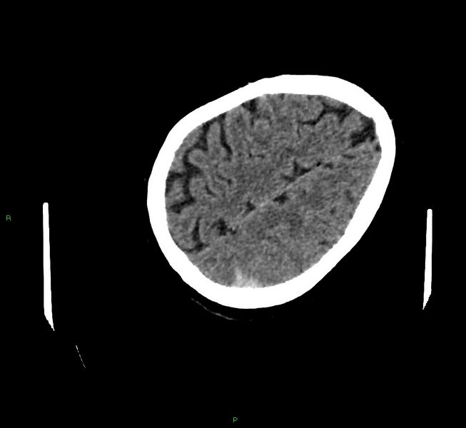File:Cerebral amyloid angiopathy-associated lobar intracerebral hemorrhage (Radiopaedia 58757-65979 Axial non-contrast 112).jpg
