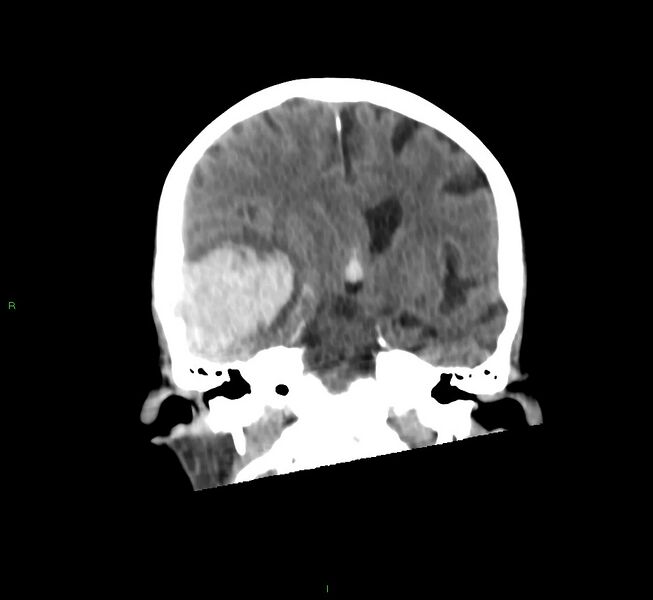 File:Cerebral amyloid angiopathy-associated lobar intracerebral hemorrhage (Radiopaedia 58758-65980 Coronal non-contrast 34).jpg