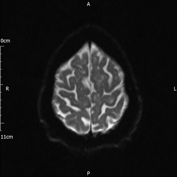 File:Cerebral amyloid angiopathy related inflammation (Radiopaedia 72772-83415 Axial DWI 20).jpg