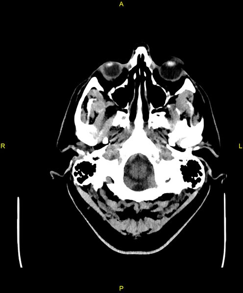 File:Cerebral autosomal dominant arteriopathy with subcortical infarcts and leukoencephalopathy (CADASIL) (Radiopaedia 86108-102051 Axial non-contrast 8).jpg