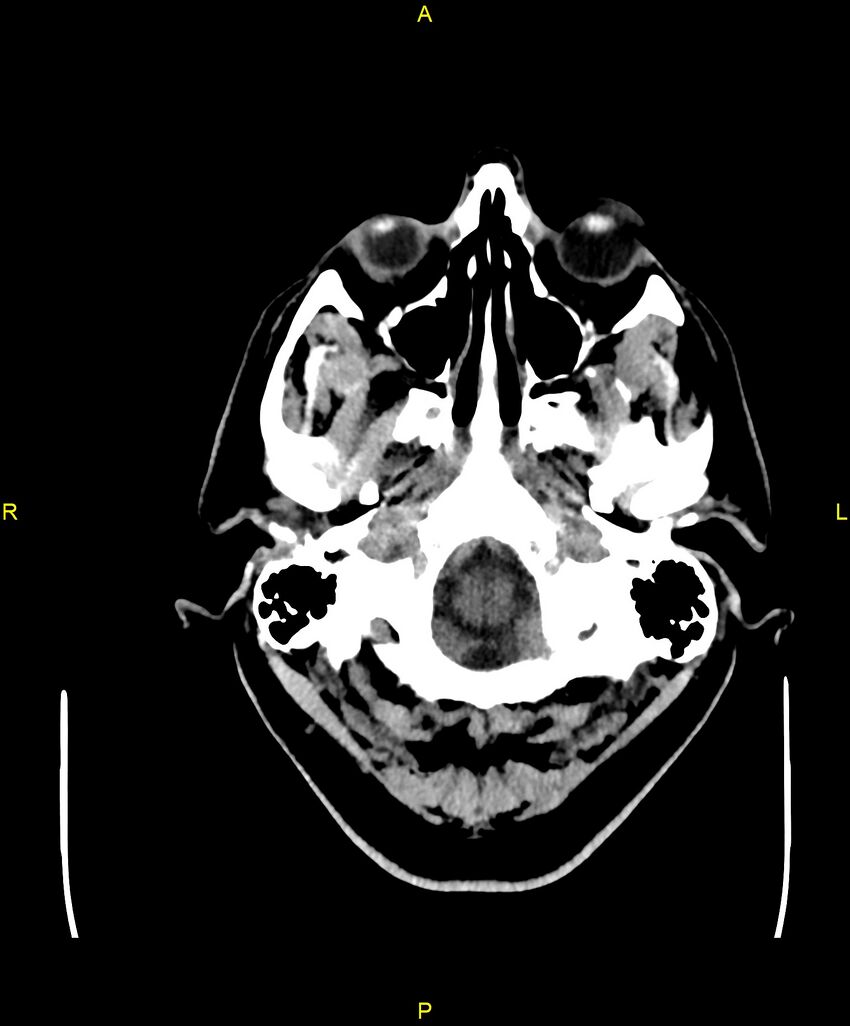 Cerebral autosomal dominant arteriopathy with subcortical infarcts and leukoencephalopathy (CADASIL) (Radiopaedia 86108-102051 Axial non-contrast 8).jpg