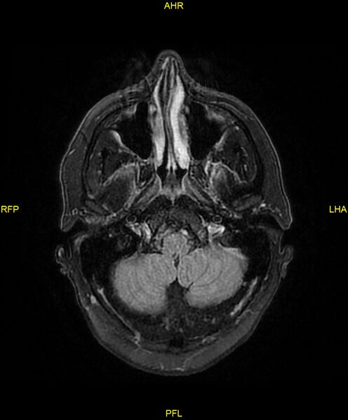 File:Cerebral autosomal dominant arteriopathy with subcortical infarcts and leukoencephalopathy (CADASIL) (Radiopaedia 86108-102054 Axial FLAIR 5).jpg