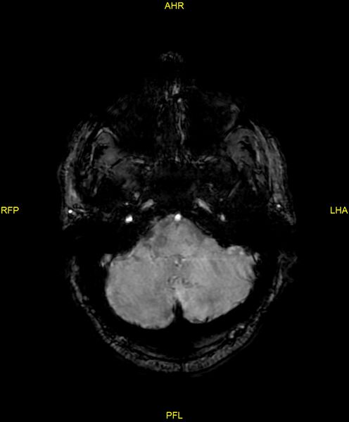 File:Cerebral autosomal dominant arteriopathy with subcortical infarcts and leukoencephalopathy (CADASIL) (Radiopaedia 86108-102054 Axial SWI 24).jpg