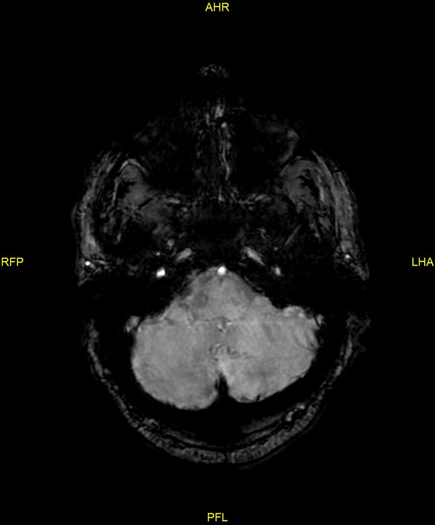 Cerebral autosomal dominant arteriopathy with subcortical infarcts and leukoencephalopathy (CADASIL) (Radiopaedia 86108-102054 Axial SWI 24).jpg