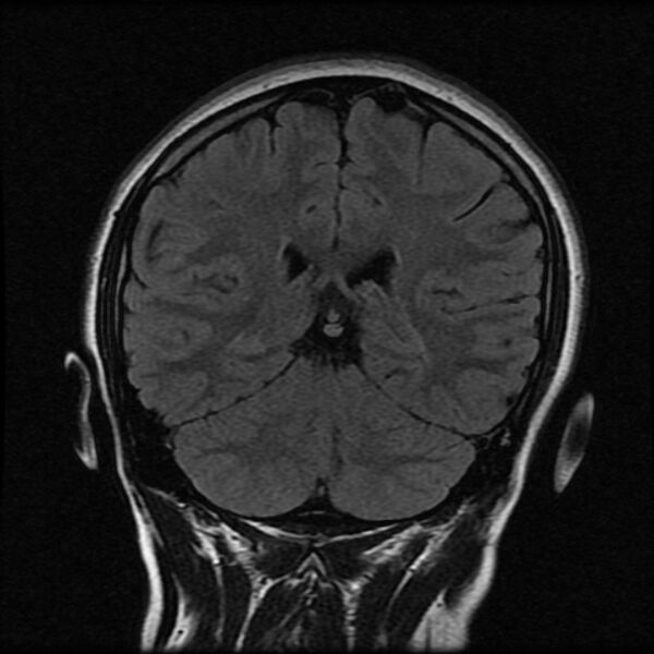 File:Cerebral cavernous malformation (Radiopaedia 44301-47942 Coronal FLAIR 16).jpg