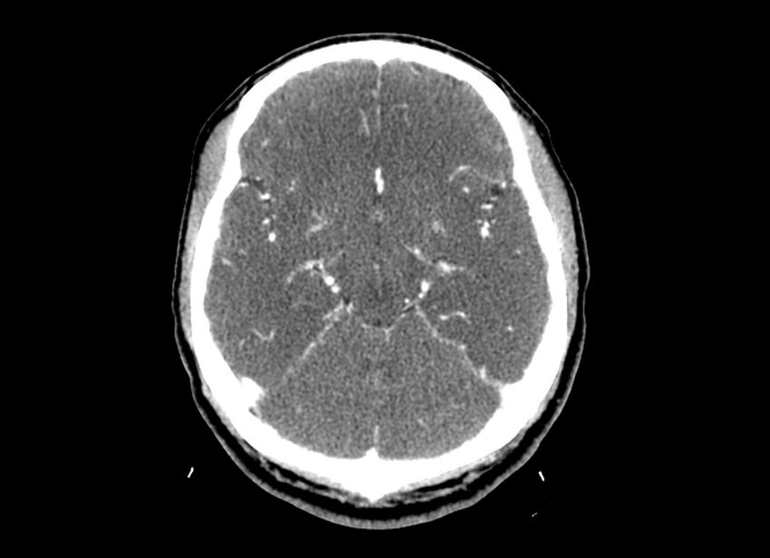 Cerebral edema (Radiopaedia 82519-96661 B 36).jpg