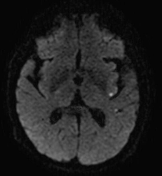 File:Cerebral embolic infarction (Radiopaedia 11288-11652 Axial 1).jpg