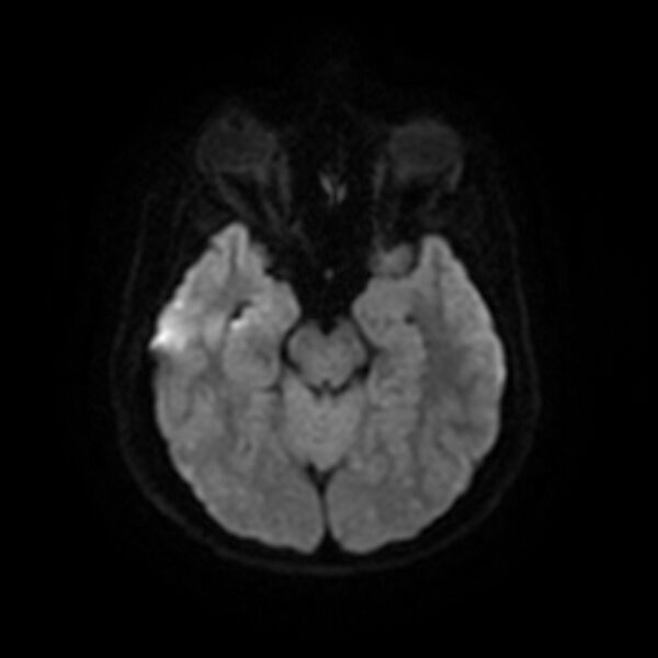 File:Cerebral fat embolism (Radiopaedia 37510-39363 Axial DWI 11).jpg