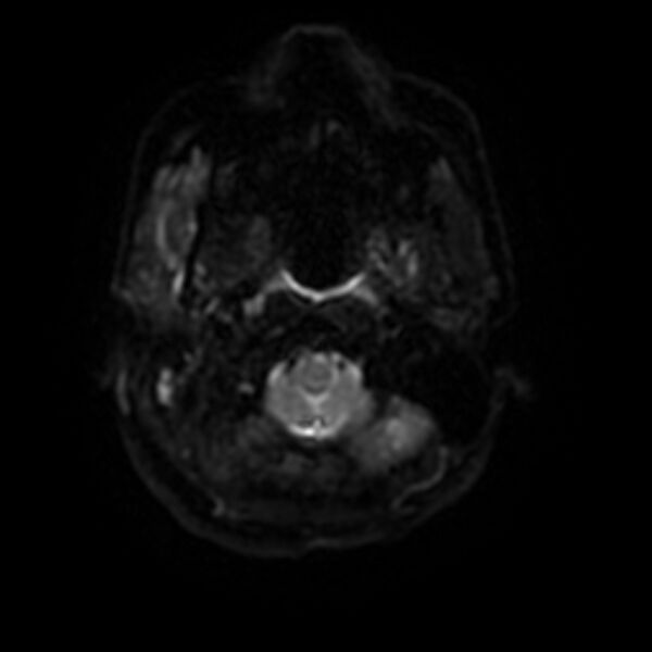 File:Cerebral fat embolism (Radiopaedia 37510-39363 Axial DWI 27).jpg