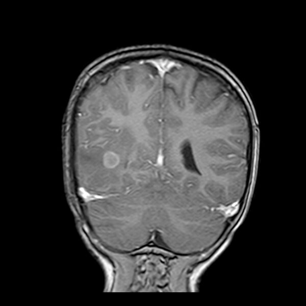 File:Cerebral tuberculoma (Radiopaedia 41152-43932 Coronal T1 C+ 16).jpg