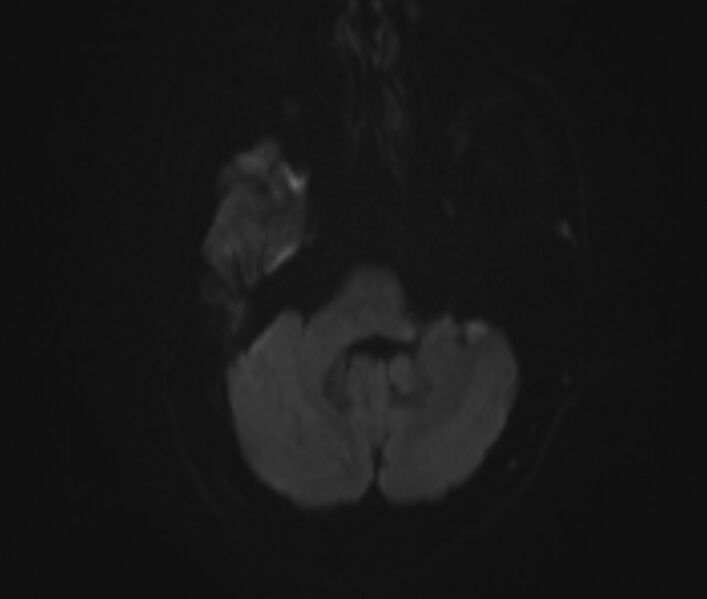 File:Cerebral venous thrombosis (Radiopaedia 71207-81504 Axial DWI 4).jpg
