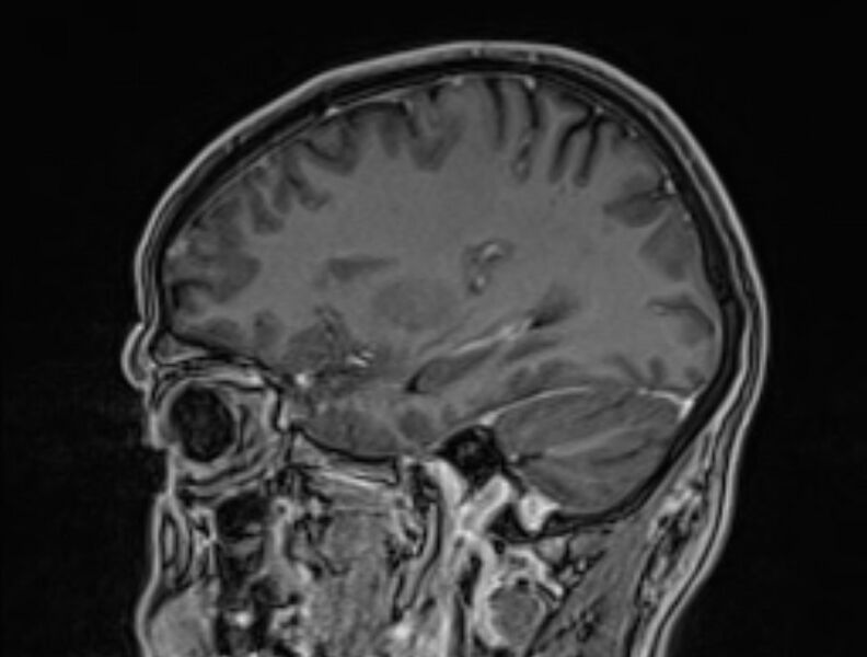 File:Cerebral venous thrombosis (Radiopaedia 71207-81504 Sagittal T1 C+ 45).jpg