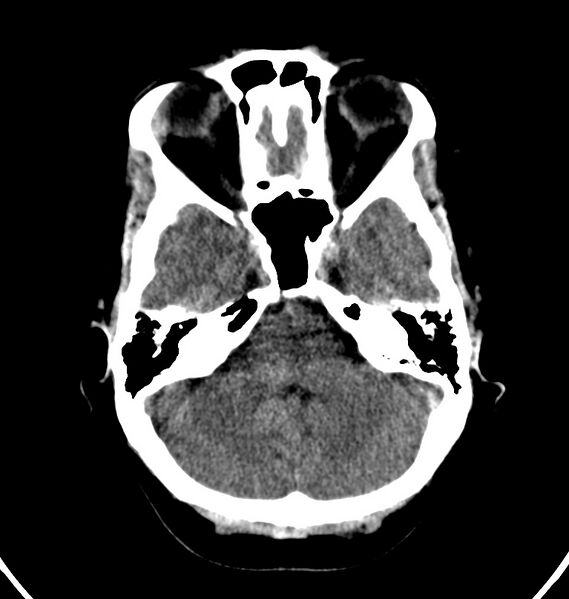 File:Cerebral venous thrombosis - CT only (Radiopaedia 41031-43778 Axial non-contrast 66).jpg