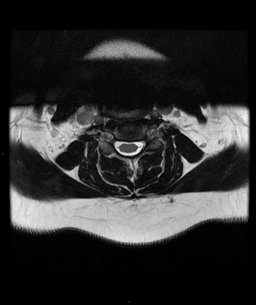Cervical disc prolapse (Radiopaedia 80258-93598 Axial T2 28).jpg