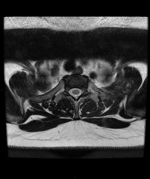 File:Cervical disc prolapse (Radiopaedia 80258-93598 Axial T2 93).jpg