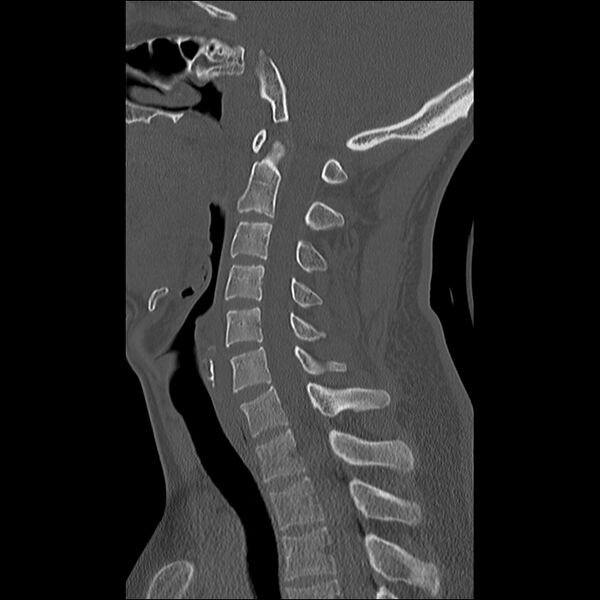 File:Cervical facet fracture and anterior discoligamentous injury (Radiopaedia 32139-33083 Sagittal bone window 17).jpg