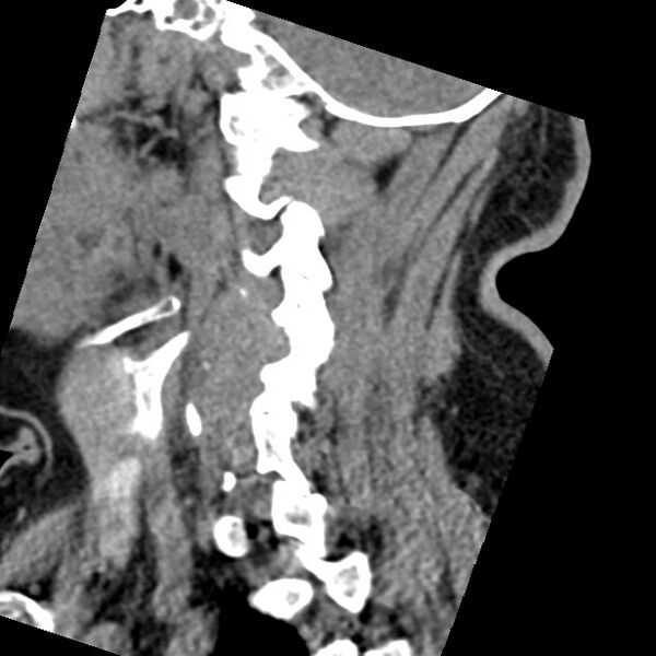 File:Cervical spinal neurofibroma in a patient with NF1 (Radiopaedia 58344-65464 C 15).jpg