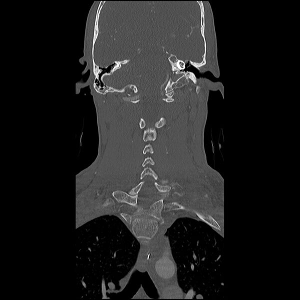 File:Cervical spine fractures with vertebral artery dissection (Radiopaedia 32135-33078 Coronal bone window 19).jpg