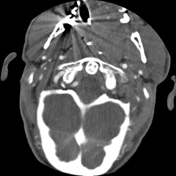 File:Cervical spine fractures with vertebral artery dissection (Radiopaedia 32135-33078 D 68).jpg