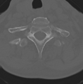 Cervical spondylolysis (Radiopaedia 49616-54811 Axial bone window 45).png