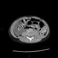 Chance fracture with duodenal and pancreatic lacerations (Radiopaedia 43477-46864 A 25).jpg
