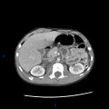 Chance fracture with duodenal and pancreatic lacerations (Radiopaedia 43477-46864 A 8).jpg