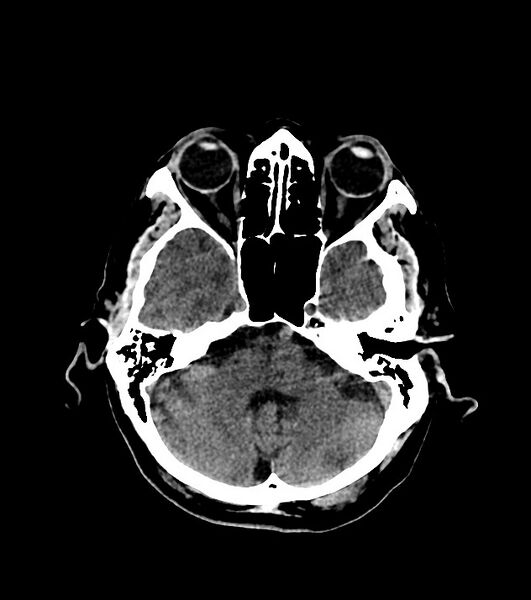 File:Cholangiocarcinoma with cerebral metastases (Radiopaedia 83519-98628 Axial non-contrast 21).jpg
