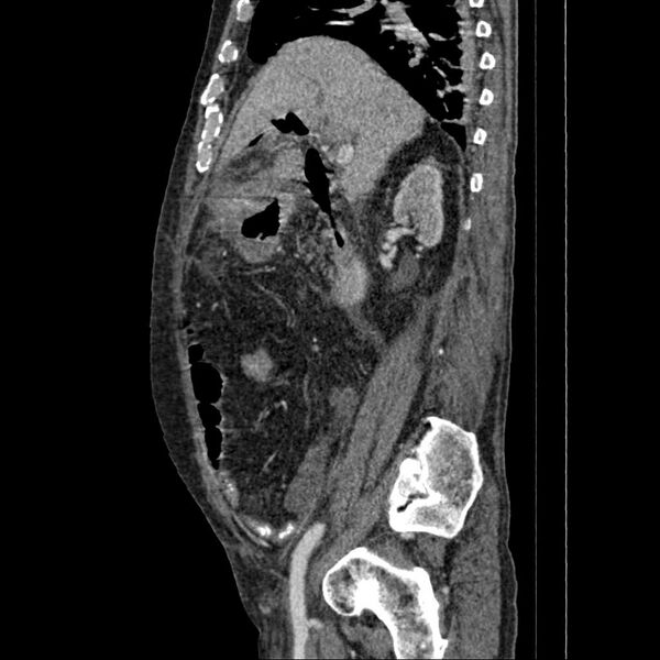 File:Cholangitis and abscess formation in a patient with cholangiocarcinoma (Radiopaedia 21194-21100 B 13).jpg