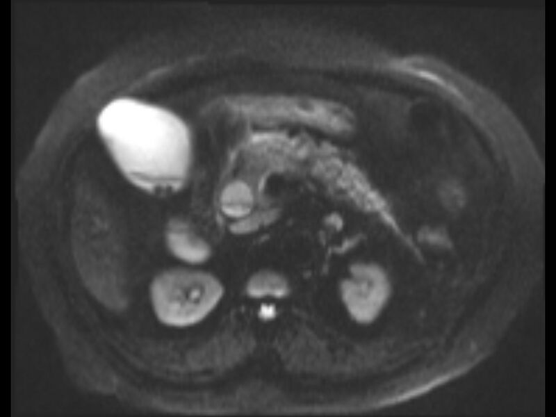 File:Choledocholithiasis causing intrahepatic biliary duct dilation (Radiopaedia 39908-42369 Axial T2 SPAIR 38).jpg
