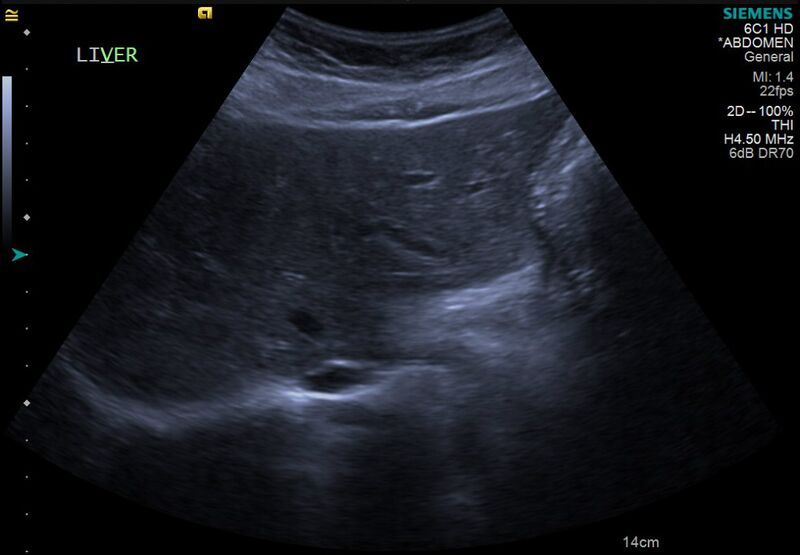 File:Cholelithiasis with biliary dilatation (Radiopaedia 49442-54588 A 1).jpg