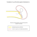 Cholesteatoma formation (illustrations) (Radiopaedia 9672-10297 Retraction 1).png