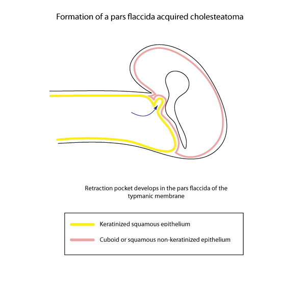 File:Cholesteatoma formation (illustrations) (Radiopaedia 9672-10297 Retraction 1).png