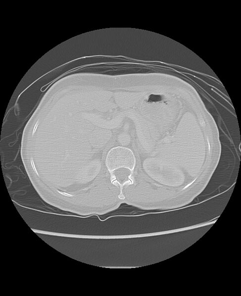 File:Chondrosarcoma (Radiopaedia 79427-92532 Axial lung window 57).jpg