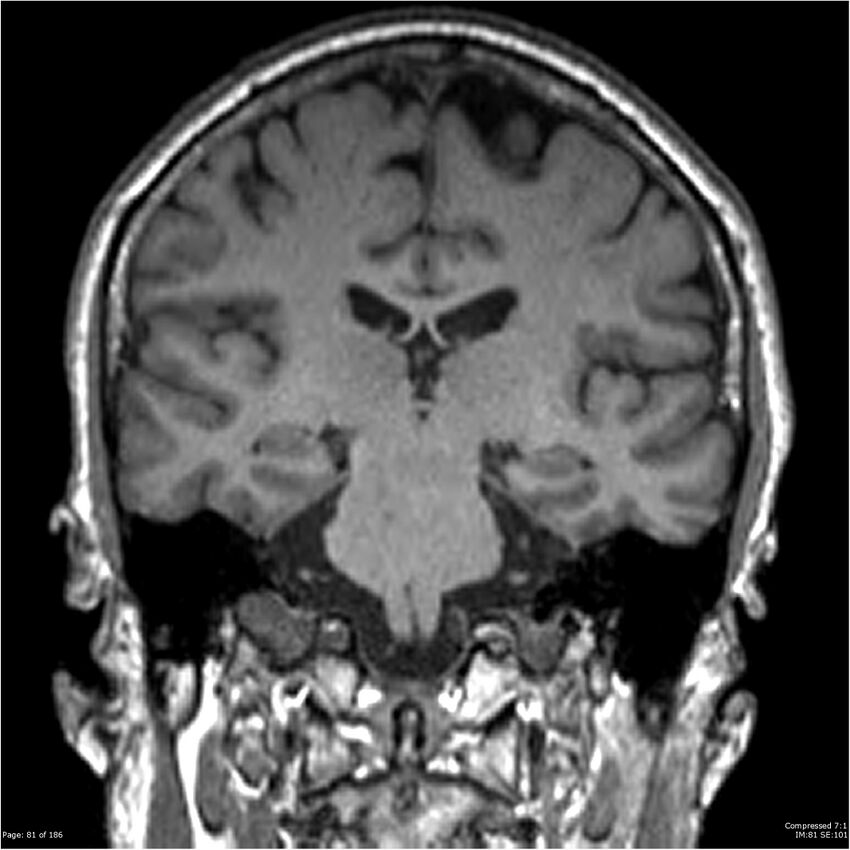 Chondrosarcoma of skull base- grade II (Radiopaedia 40948-43654 Coronal T1 2).jpg