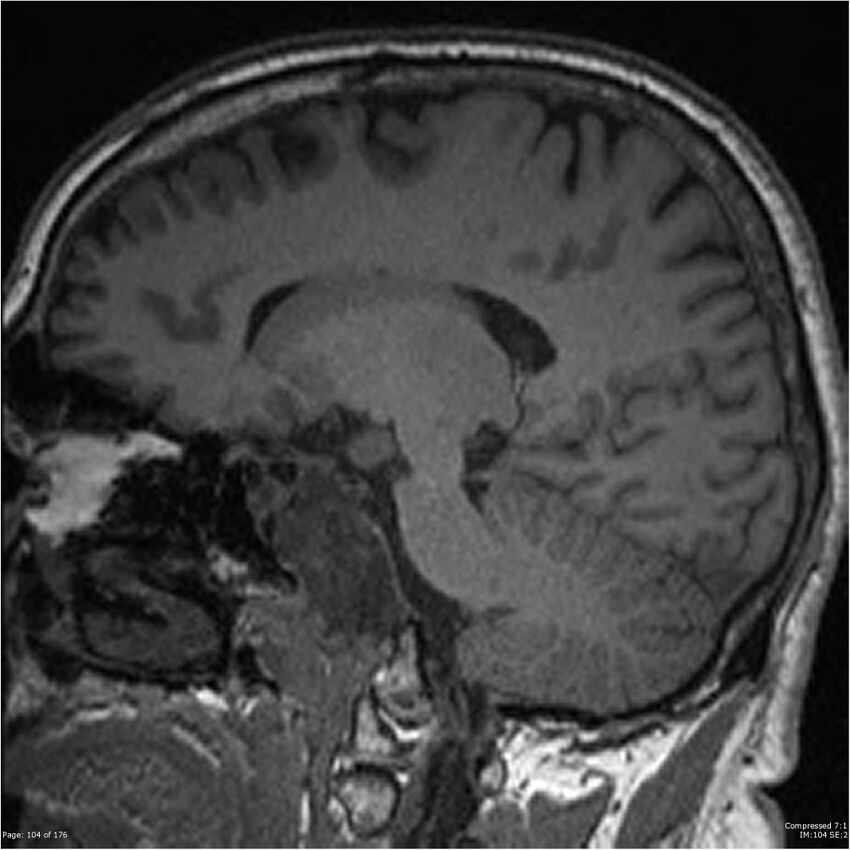Chondrosarcoma of skull base- grade II (Radiopaedia 40948-43654 Sagittal T1 27).jpg